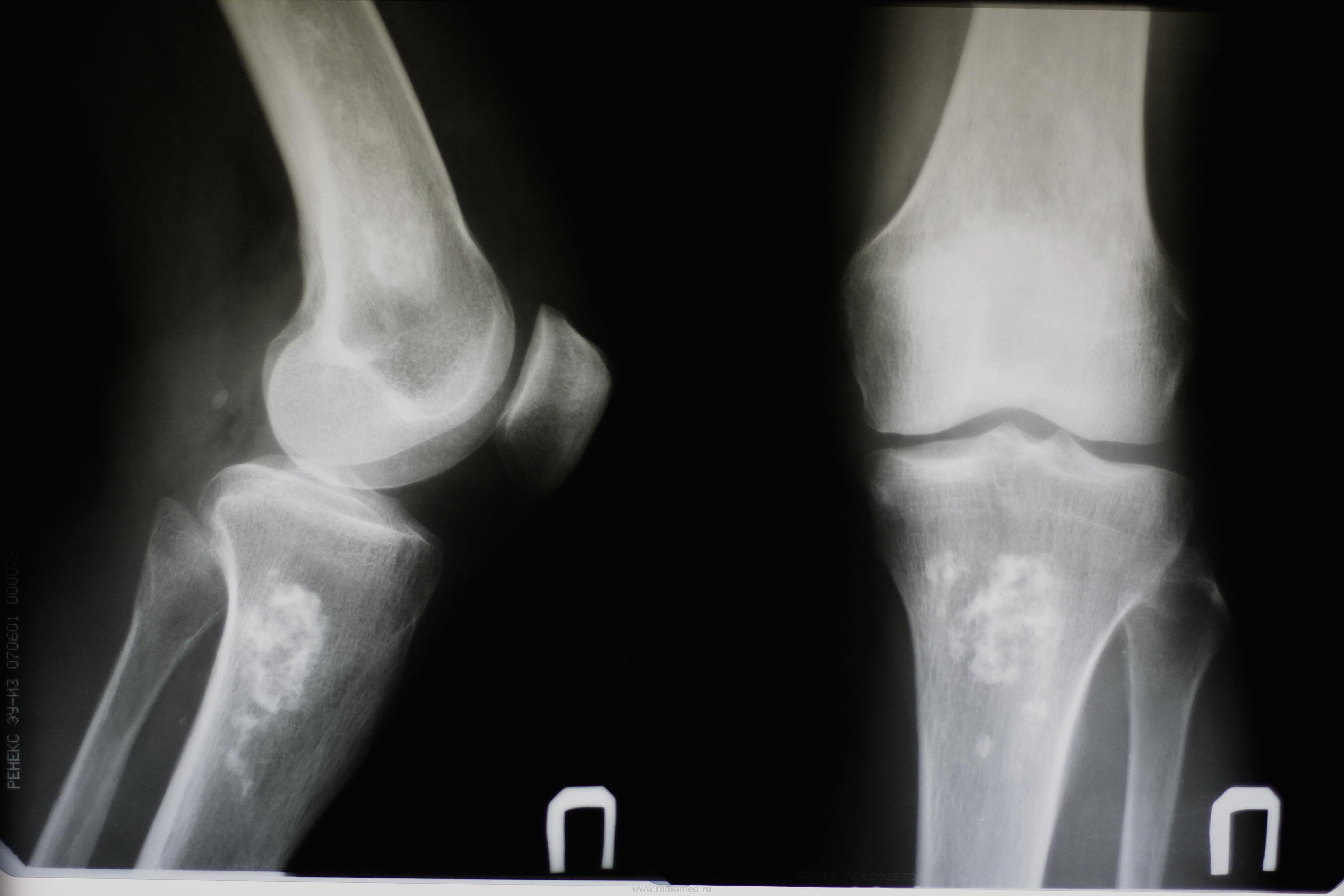 Изображение коленного сустава рентгеновское
