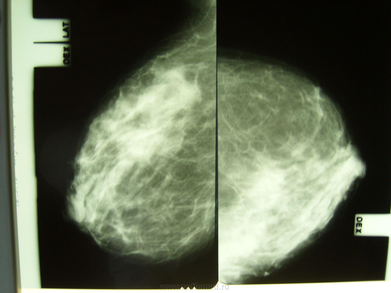 Тепловизорная маммография