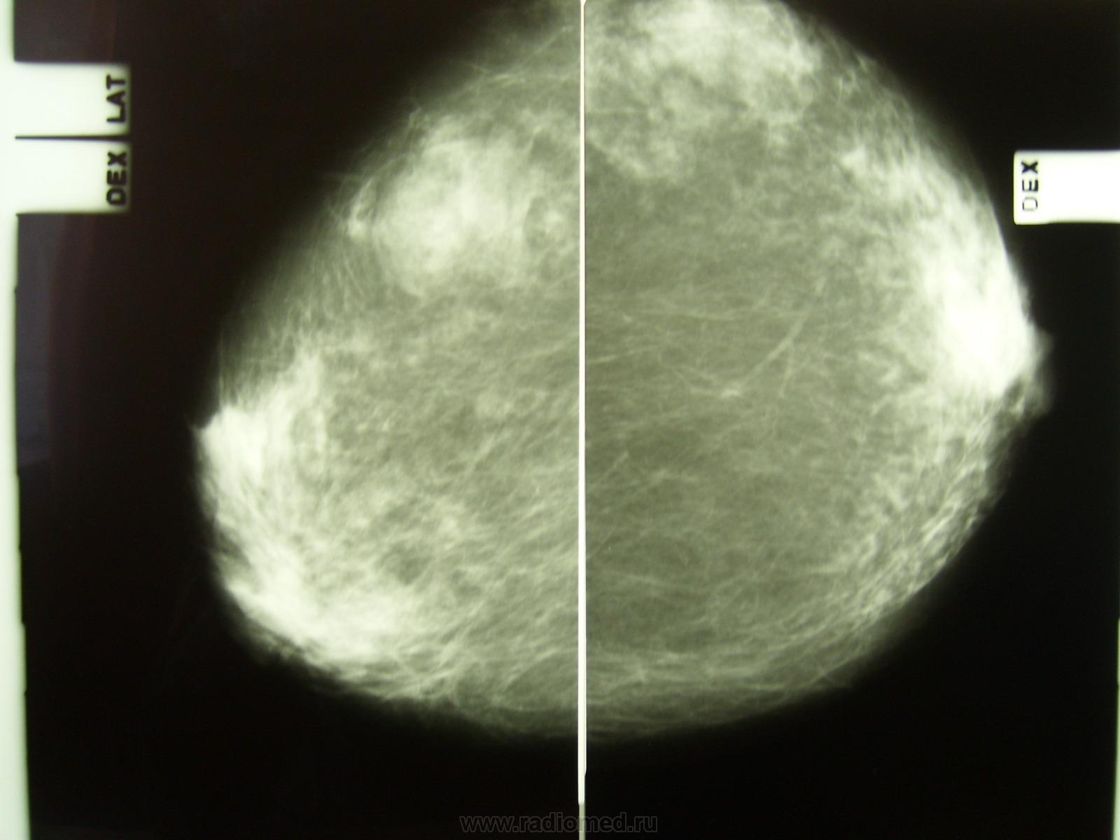 Тепловизорная маммография