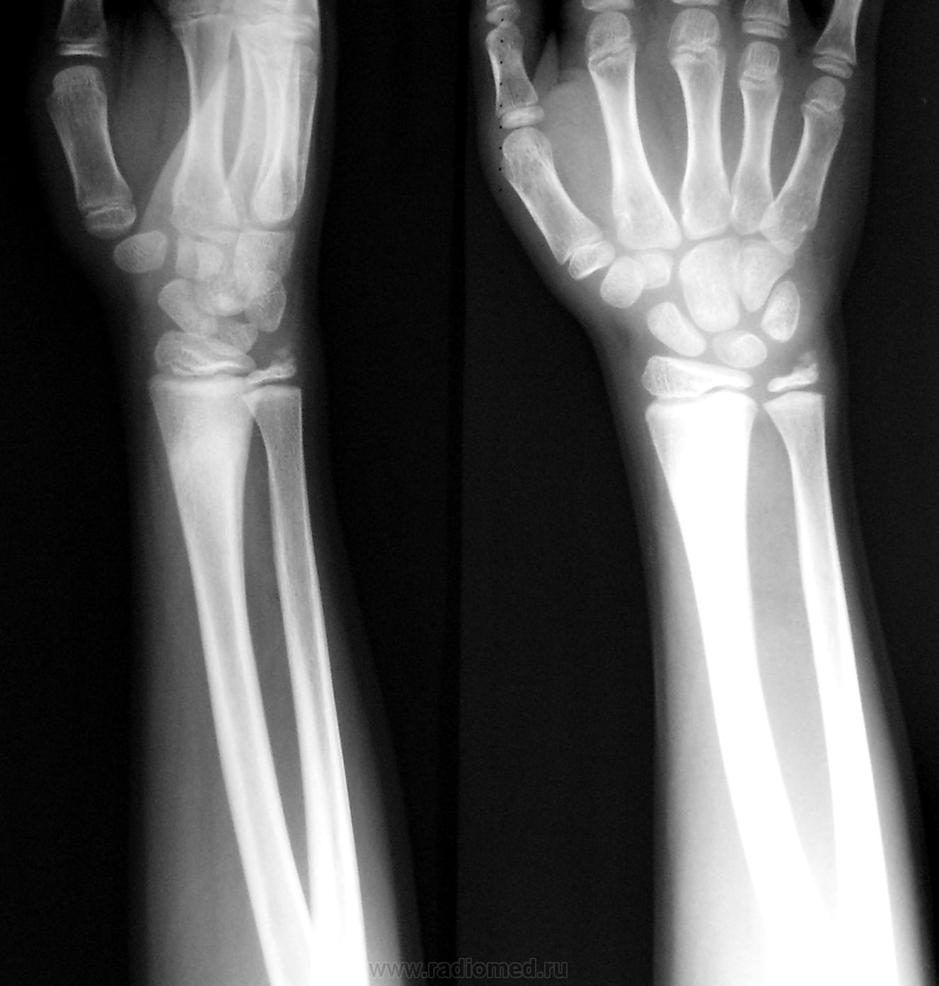 Трещина в кисти. Рентген перелома кости предплечья. Перелом 3 локтевой кости руки. Перелом лучезапястного сустава рентген. Рентген лучевой кости руки.