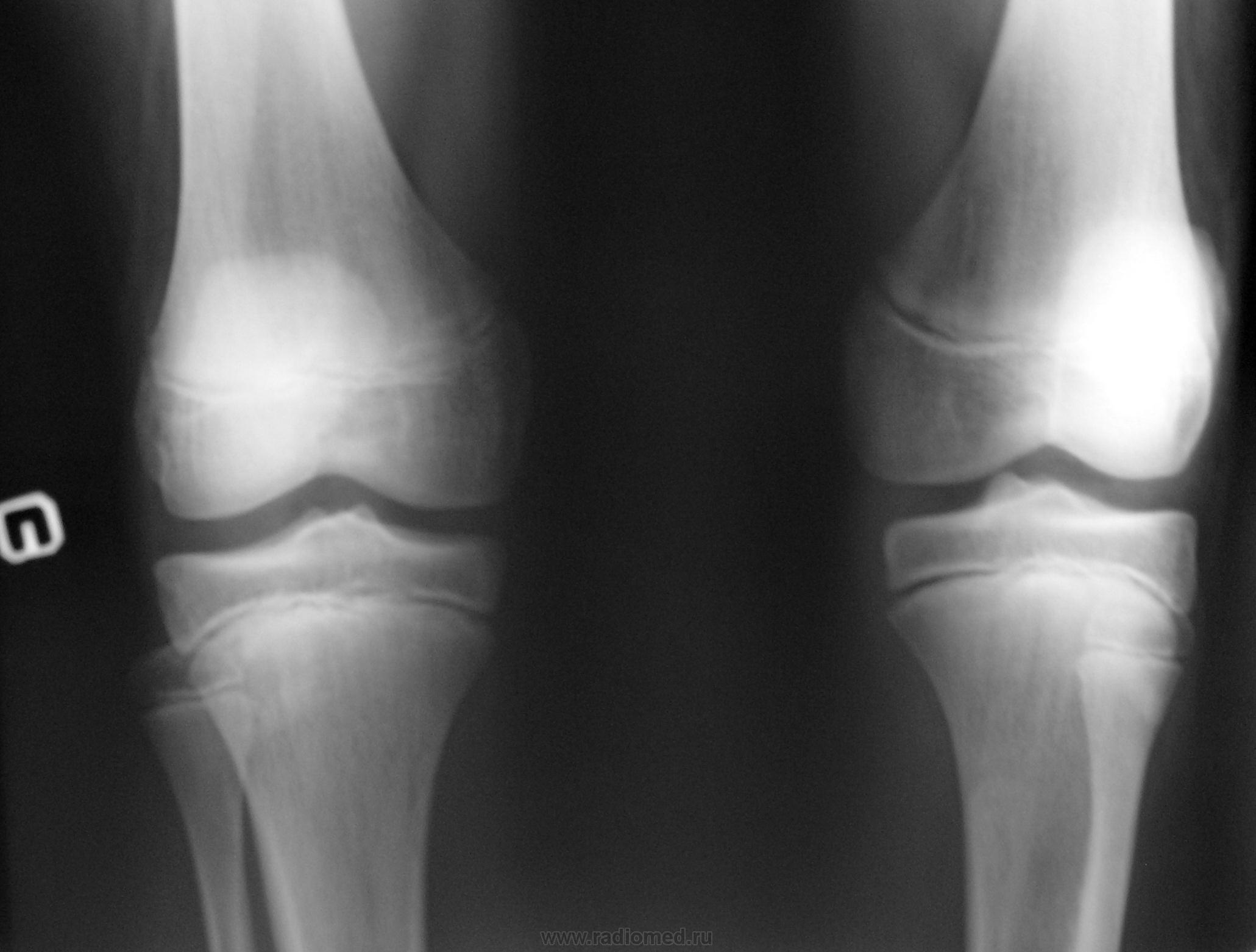 Ревматоидный артрит коленного сустава рентген