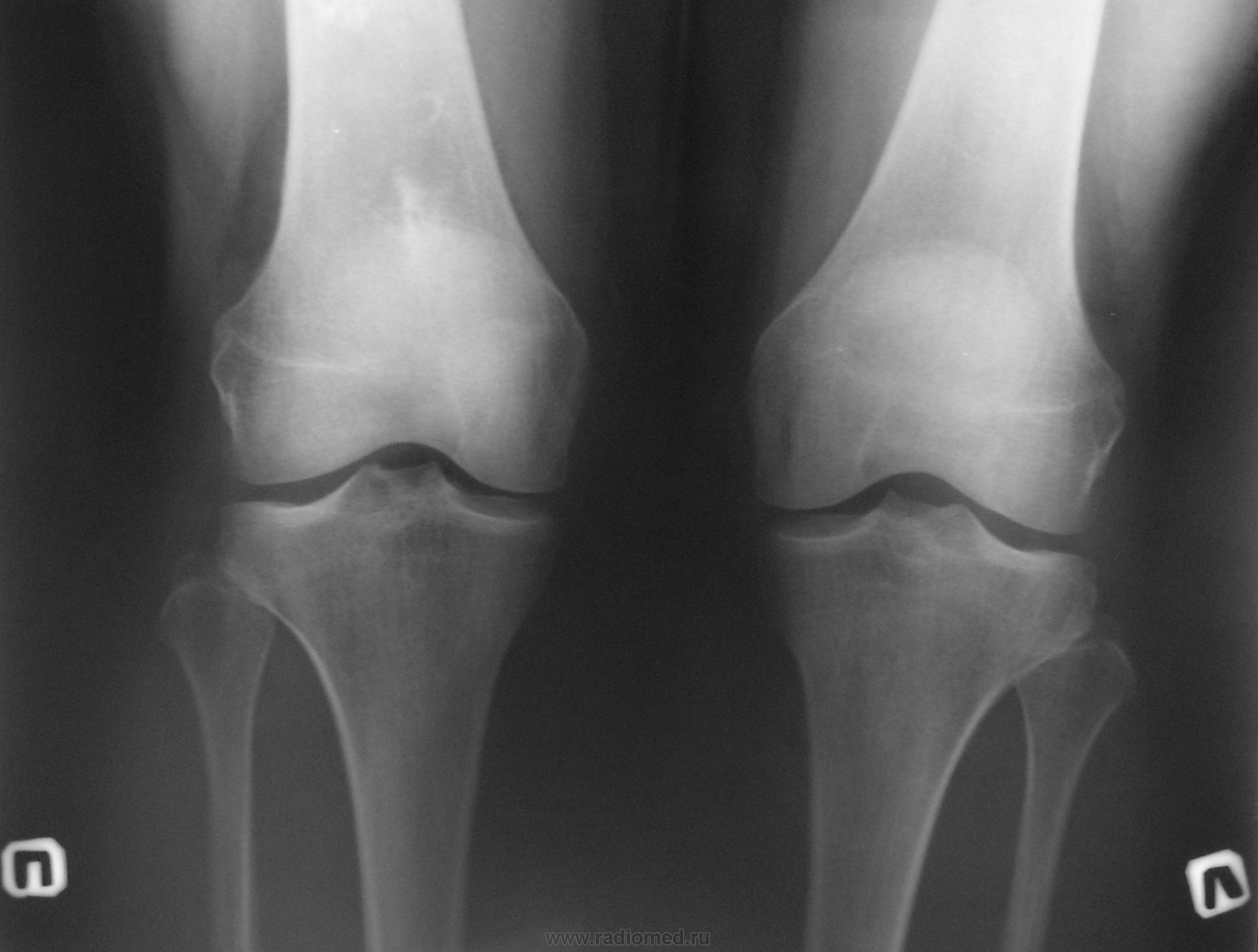Рентген коленного сустава фото как делают
