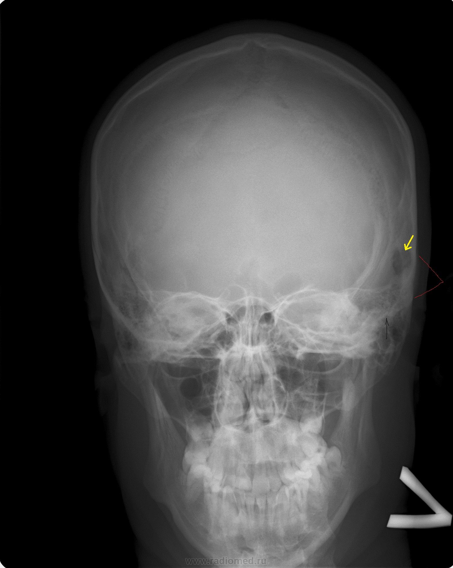 Перелом затылочной кости черепа рентген