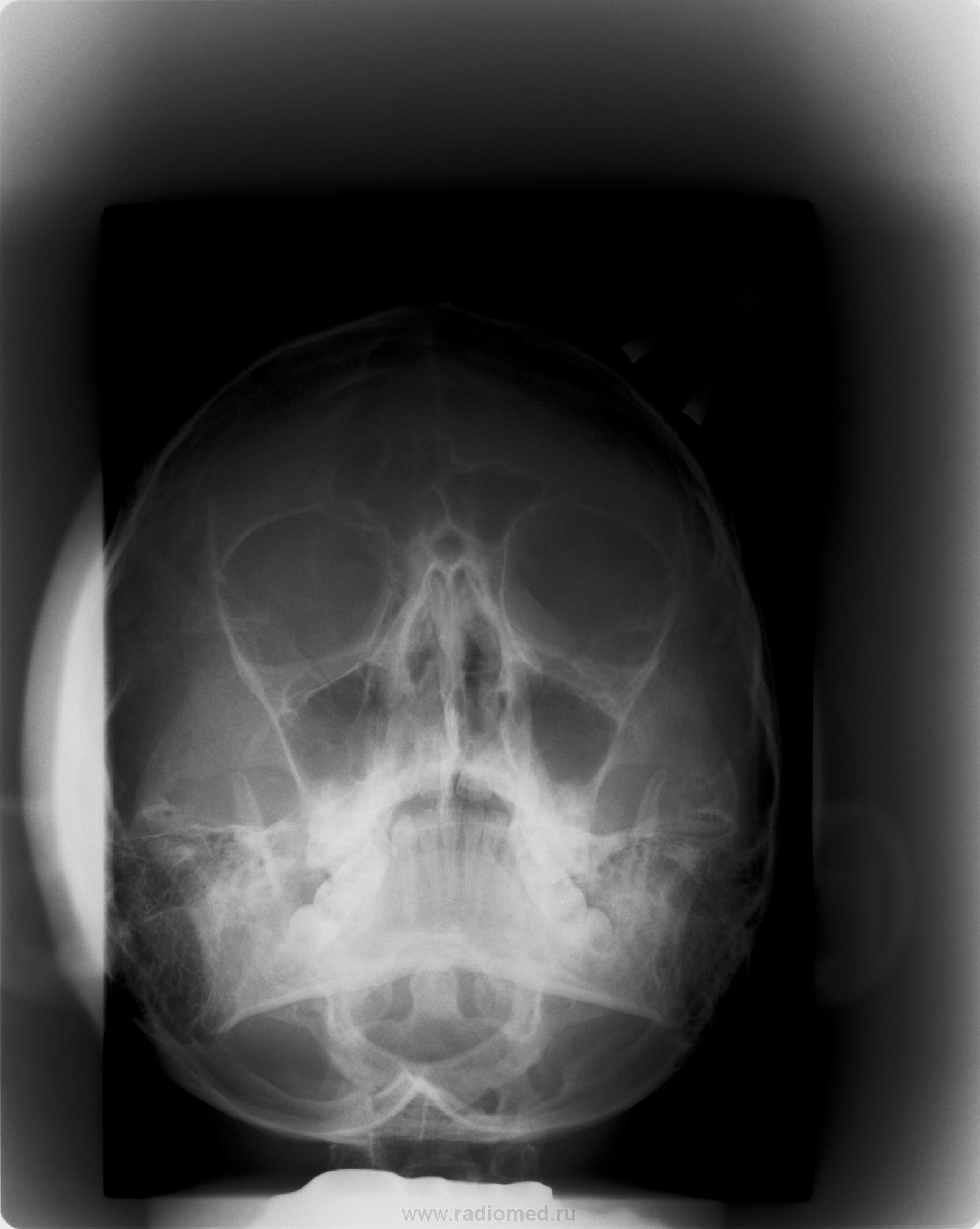 При укладке черепа в прямой проекции центральный луч направлен к доске стола