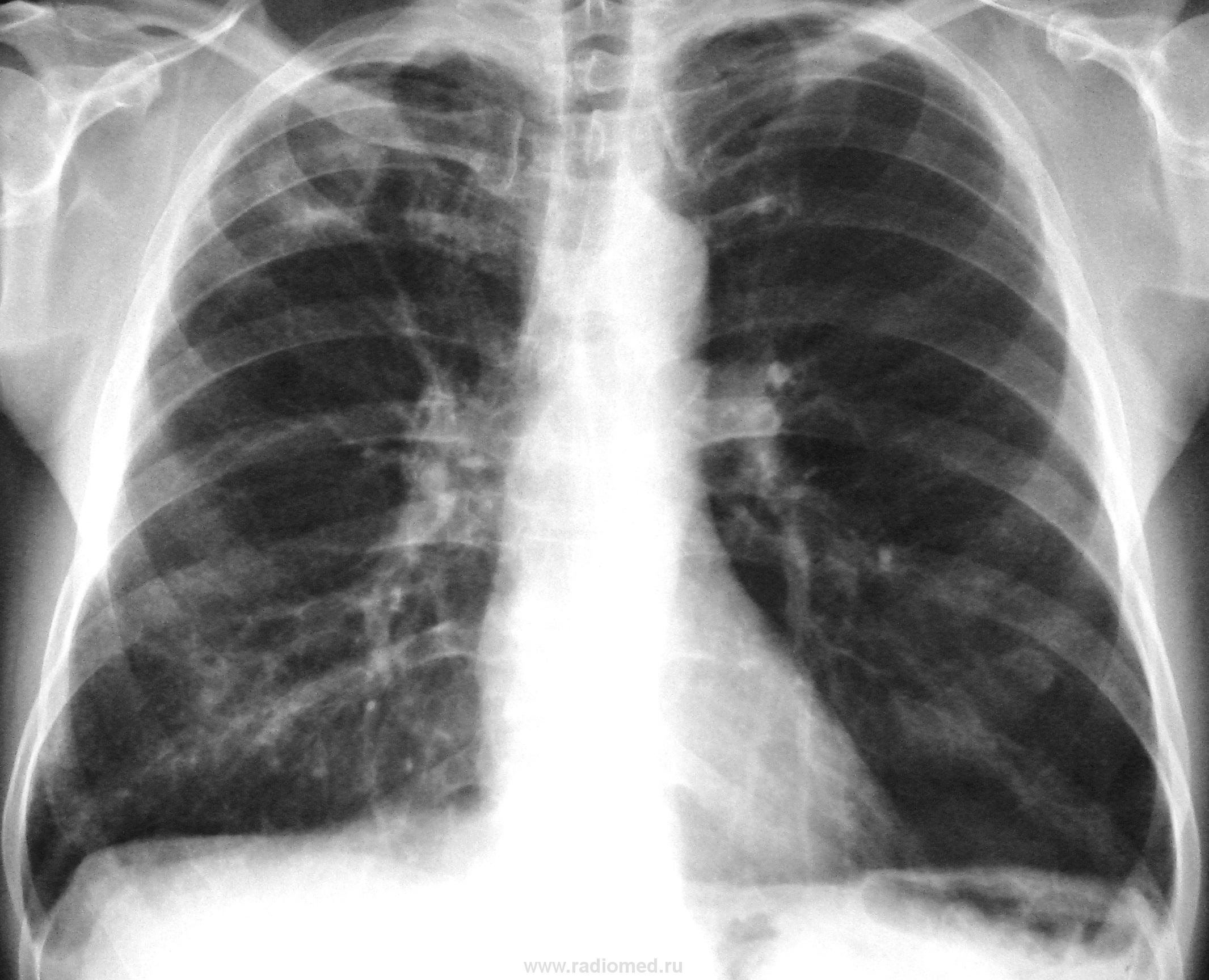 Туберкулез легких рентген