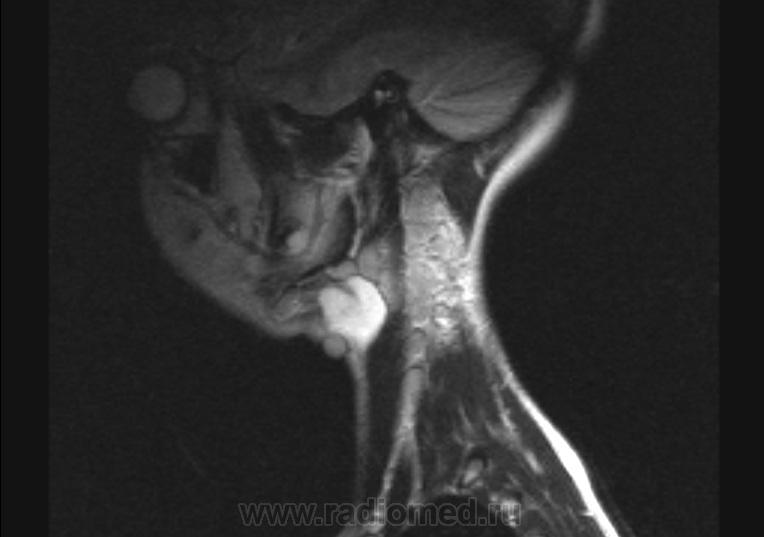 Мрт шеи. Срединная киста шеи мрт. Мрт мягких тканей шеи с контрастом.