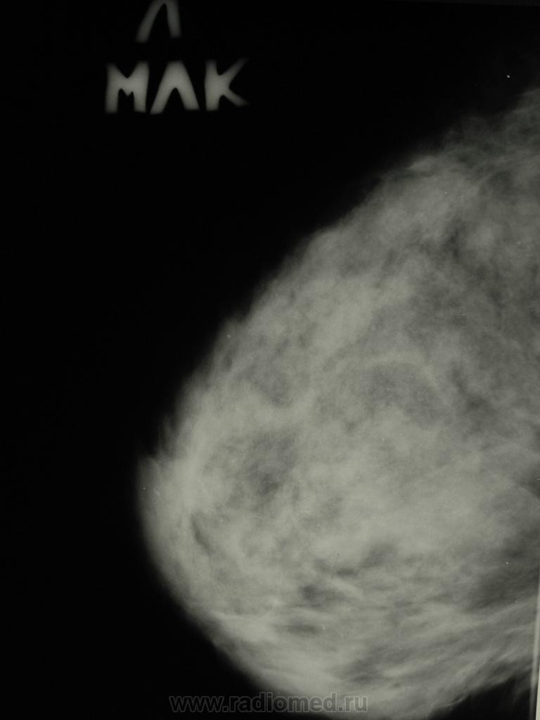 Аденоз на маммографии. Склерозирующий аденоз маммография. Аденоз молочных желез на маммографии.