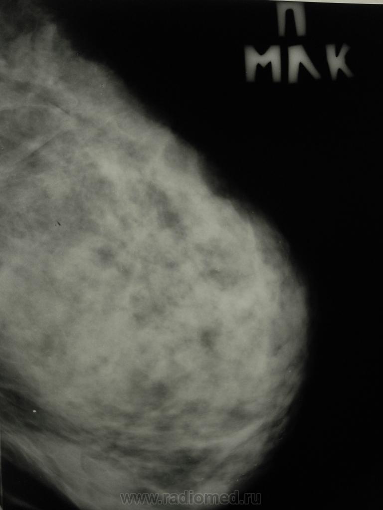 Аденоз на маммографии. Склерозирующий аденоз маммография. Склерозирующий аденоз молочной железы на рентгене. Склерозирующий аденоз молочных желез на рентгене что это.