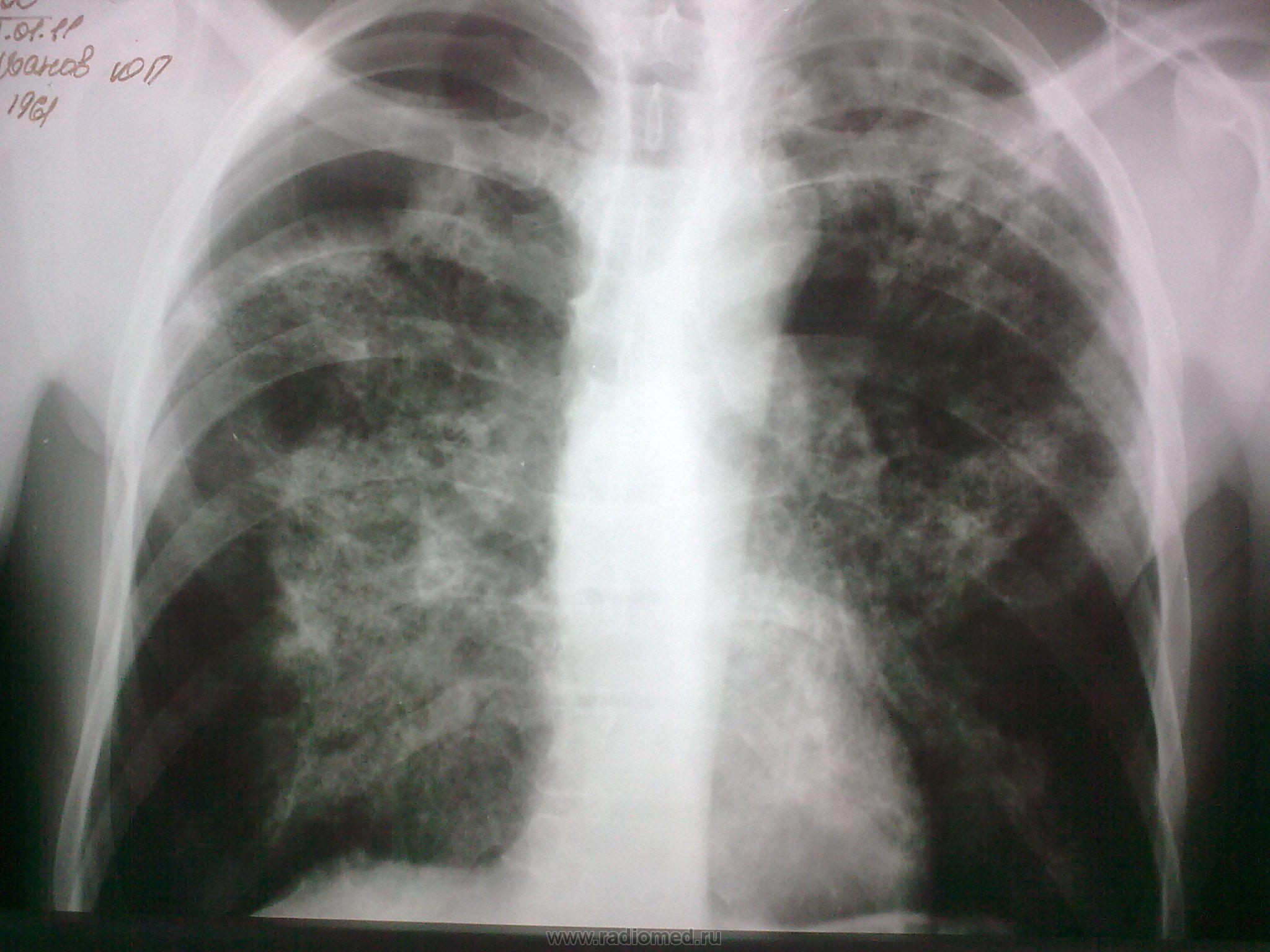 Пневмония снимки легких флюорография