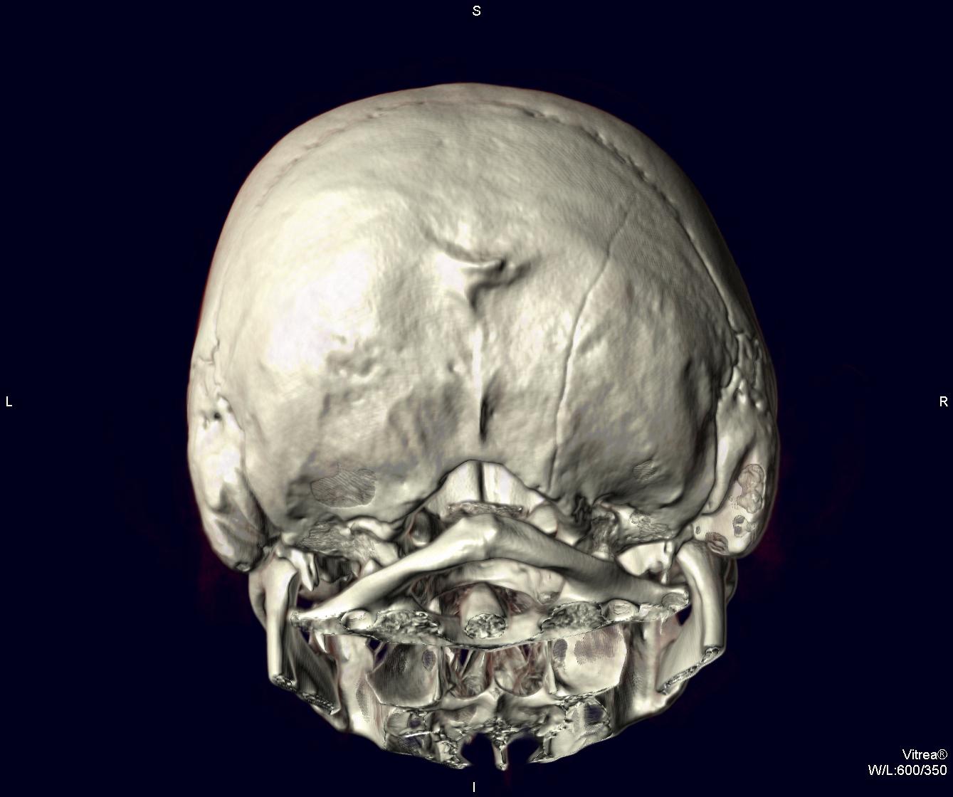 Кость на затылке. Перелом черепа на рентгене лобной кости. Перелом лобной кости черепа. Оскольчатый перелом затылочной кости. Перелом затылочной кости черепа.
