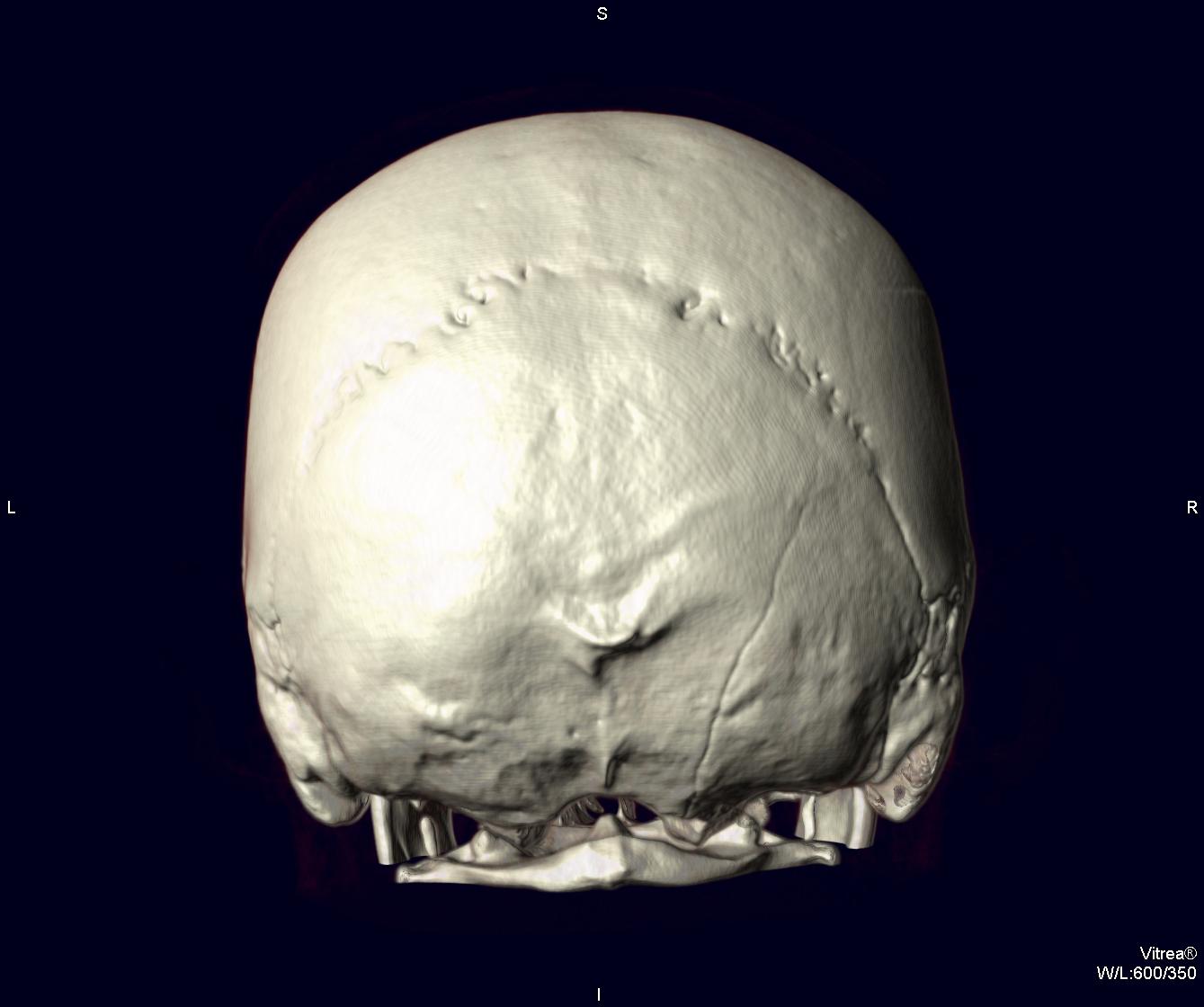 Теменная кость черепа перелом