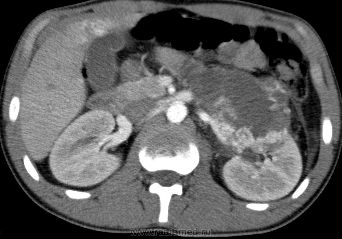 Забрюшинные неорганные саркомы. Лимфома забрюшинного пространства кт. Лимфома брюшной полости на кт.