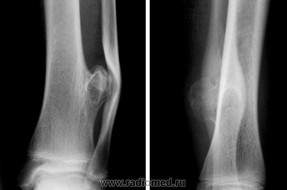 Экхондрома рентгенологическая картина