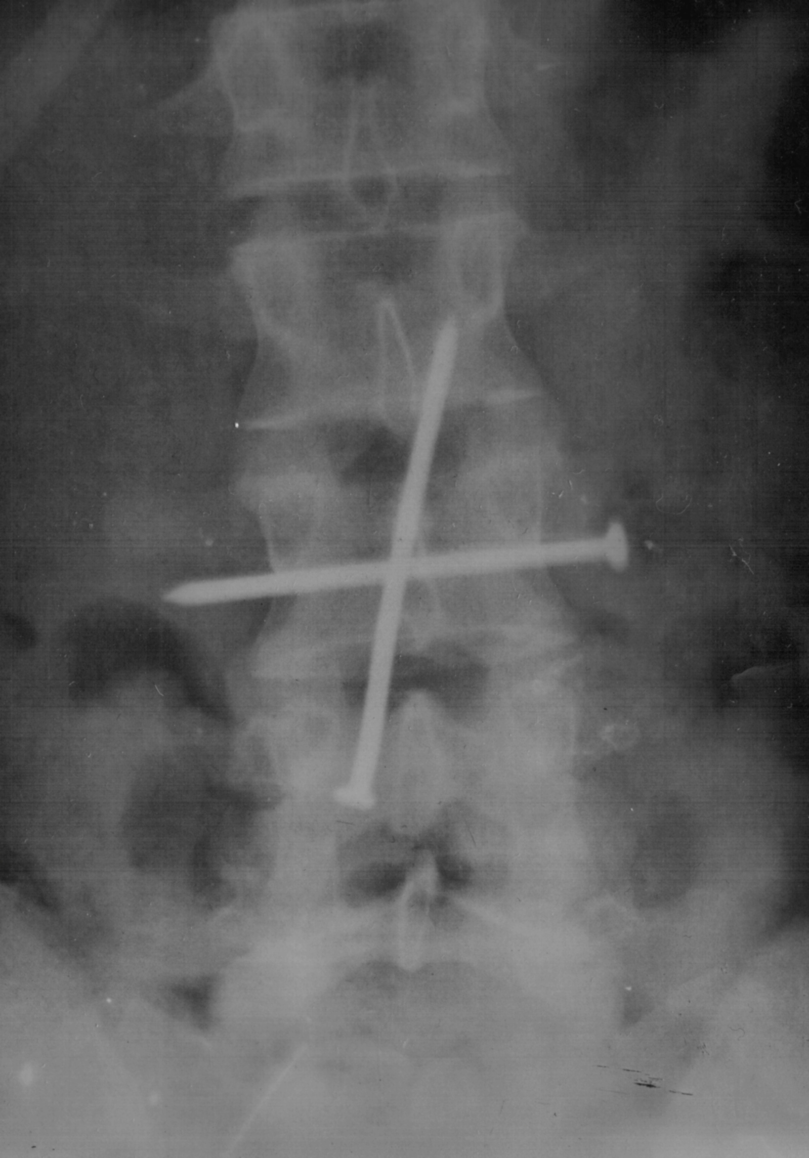 Инородное тело в желудке рентген
