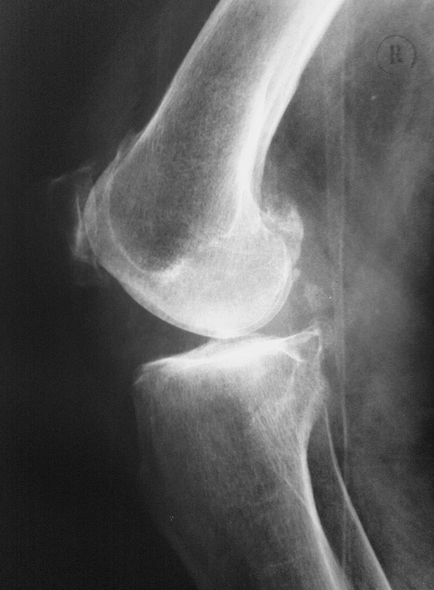 Рентген колена. Остеоартроз коленного сустава рентген снимок.