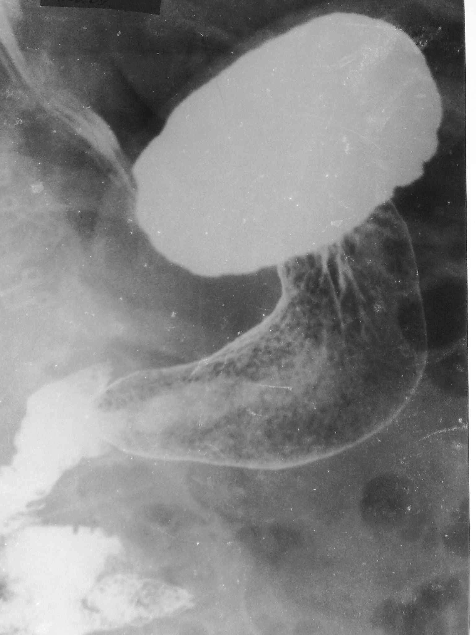 Гастрит антрального отдела желудка рентген