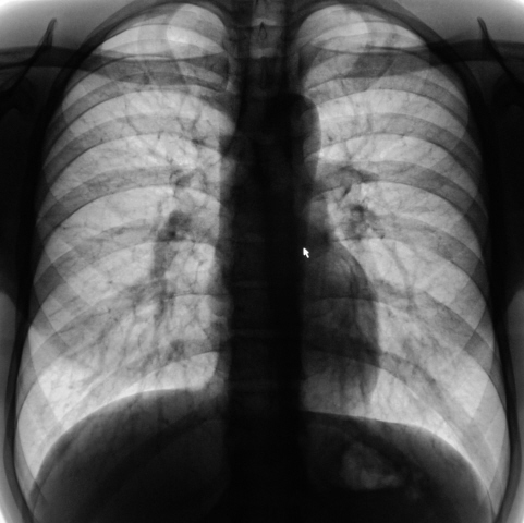 Как выглядит туберкулез на рентгеновских снимках фото