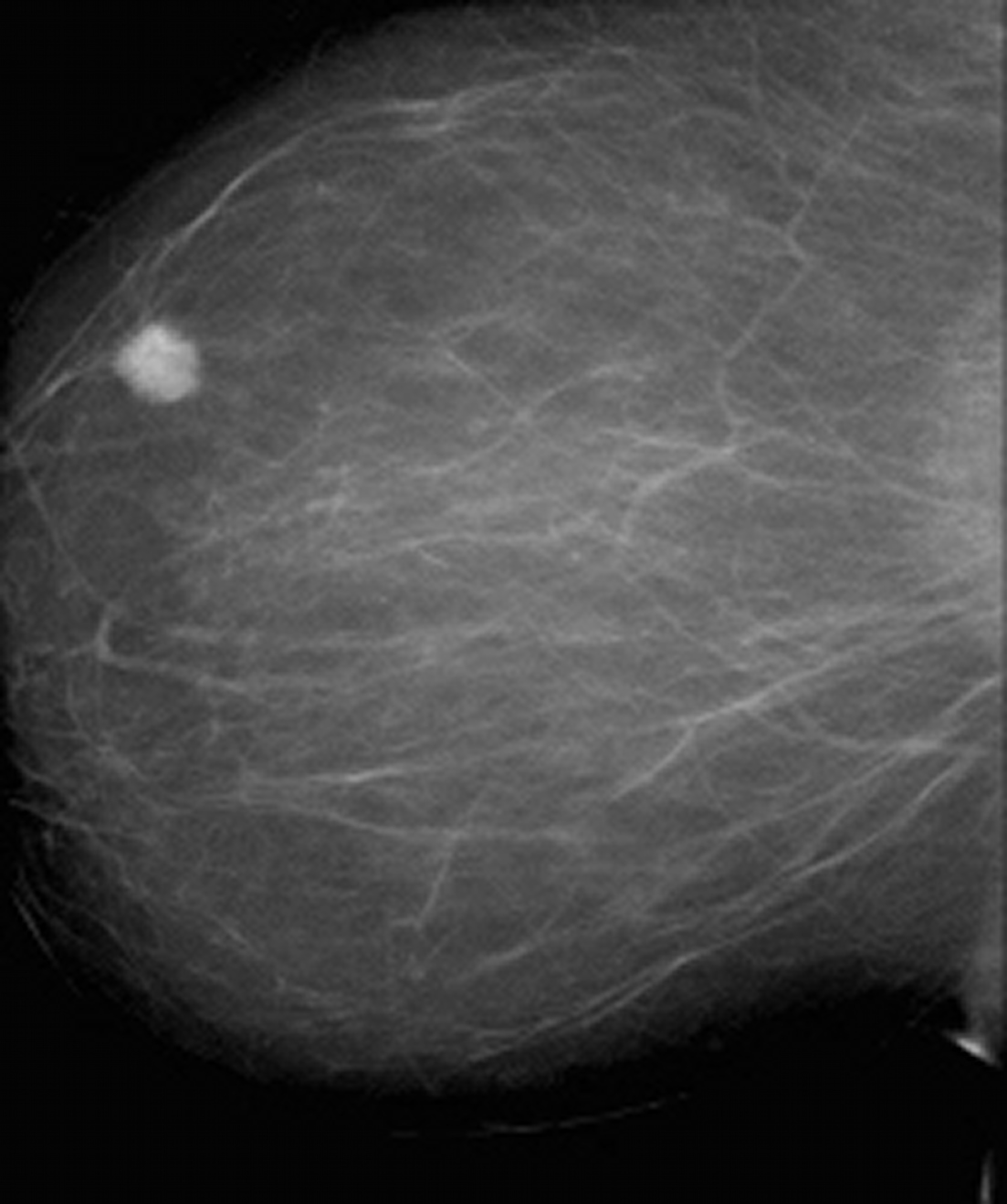 Фиброма в груди. Узловая формарак молочной железы. Фибросаркома маммография. Маммография раковая опухоль молочной железы. Обызвествленная киста молочной железы на маммографии.