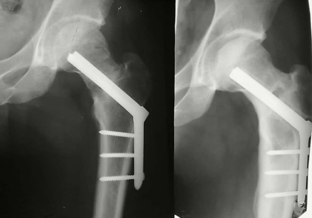 Сломана шейка бедра операция. Оскольчатый перелом шейки бедра рентген. Чрезвертельный перелом остеосинтез. Остеосинтез шейки бедра рентген. Остеосинтез бедра пластиной рентген.