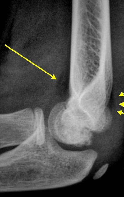 Симптом подушки. Остеохондропатия локтевого отростка. Остеохондропатия локтевого сустава рентген. Остеохондропатия Паннера. Остеохондропатия локтевой кости.