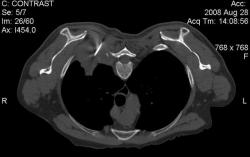 Lung Biopsy
