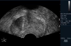 Prostatic biopsy