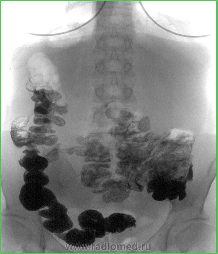 Ирригоскопия это рентгенологическое контрастное. Ирригоскопия дивертикулез. Ирригоскопия с двойным контрастированием. Дивертикулез кишечника рентген. Ирригоскопия синдром Пайра.