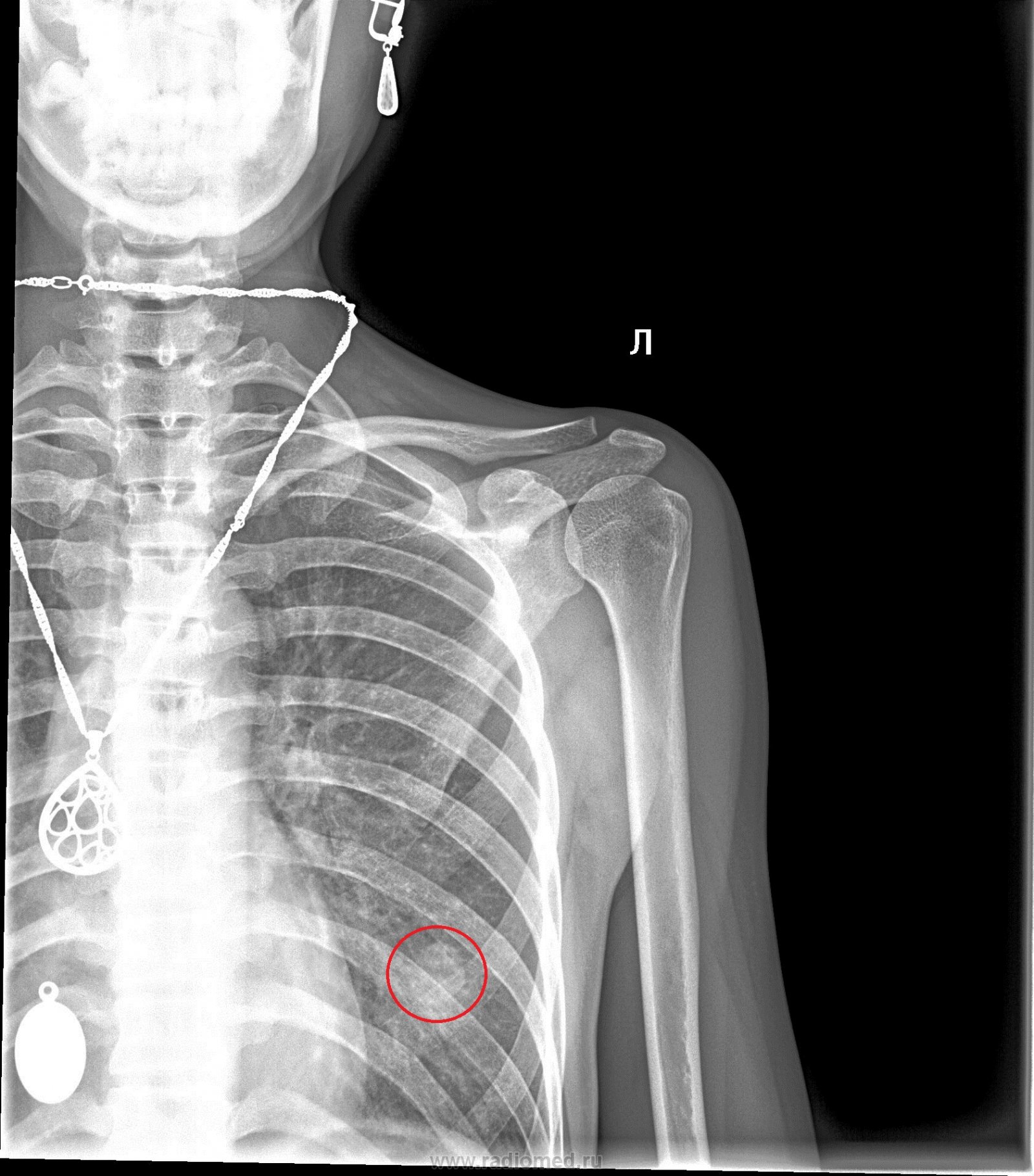 Болит плечо | Портал радиологов
