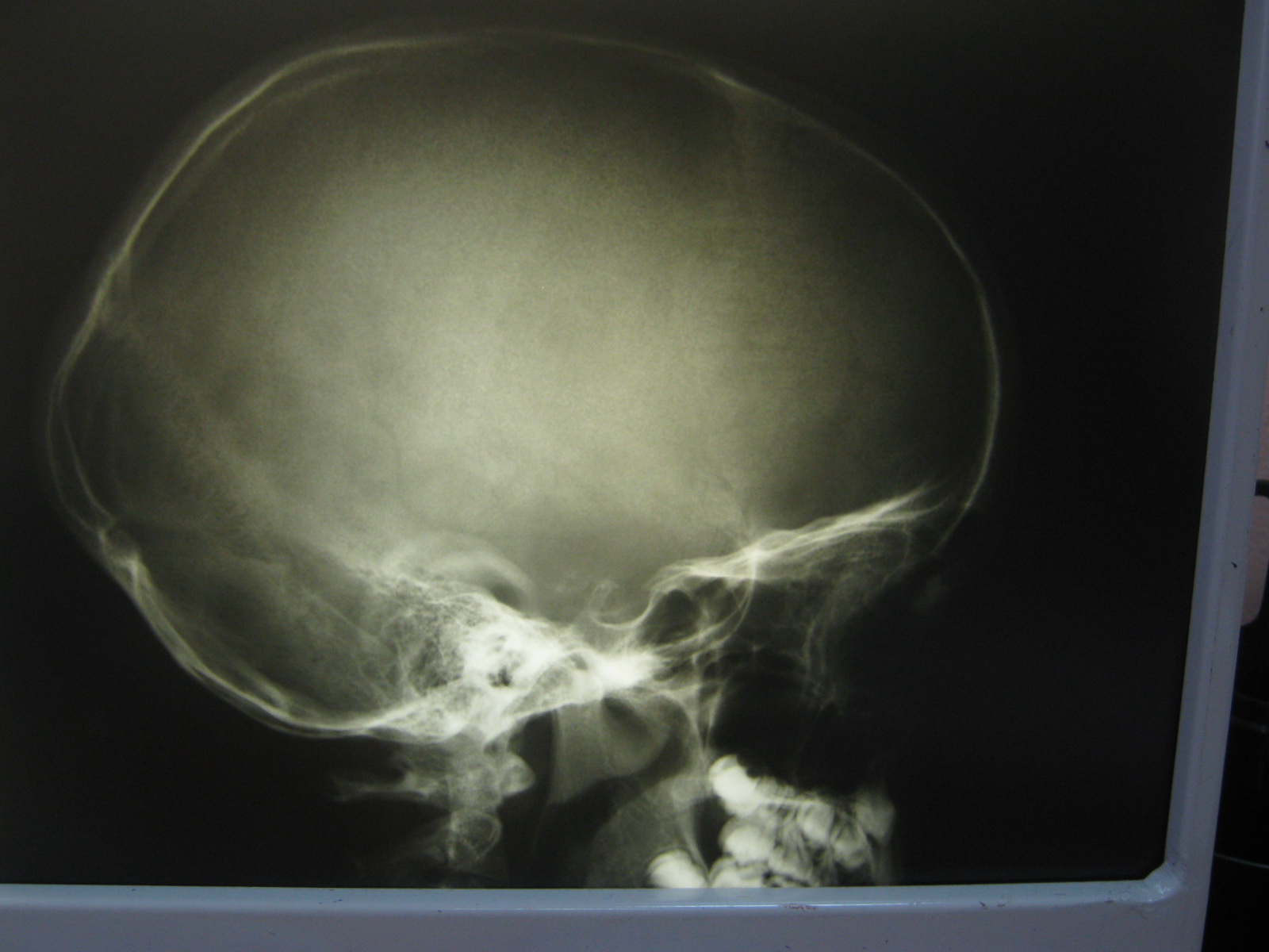 Детский череп рентген. Гидроцефалия на рентгене черепа. Рентгенограмма черепа ребенка. Рентген черепа младенца. Детский череп рентген снимок.