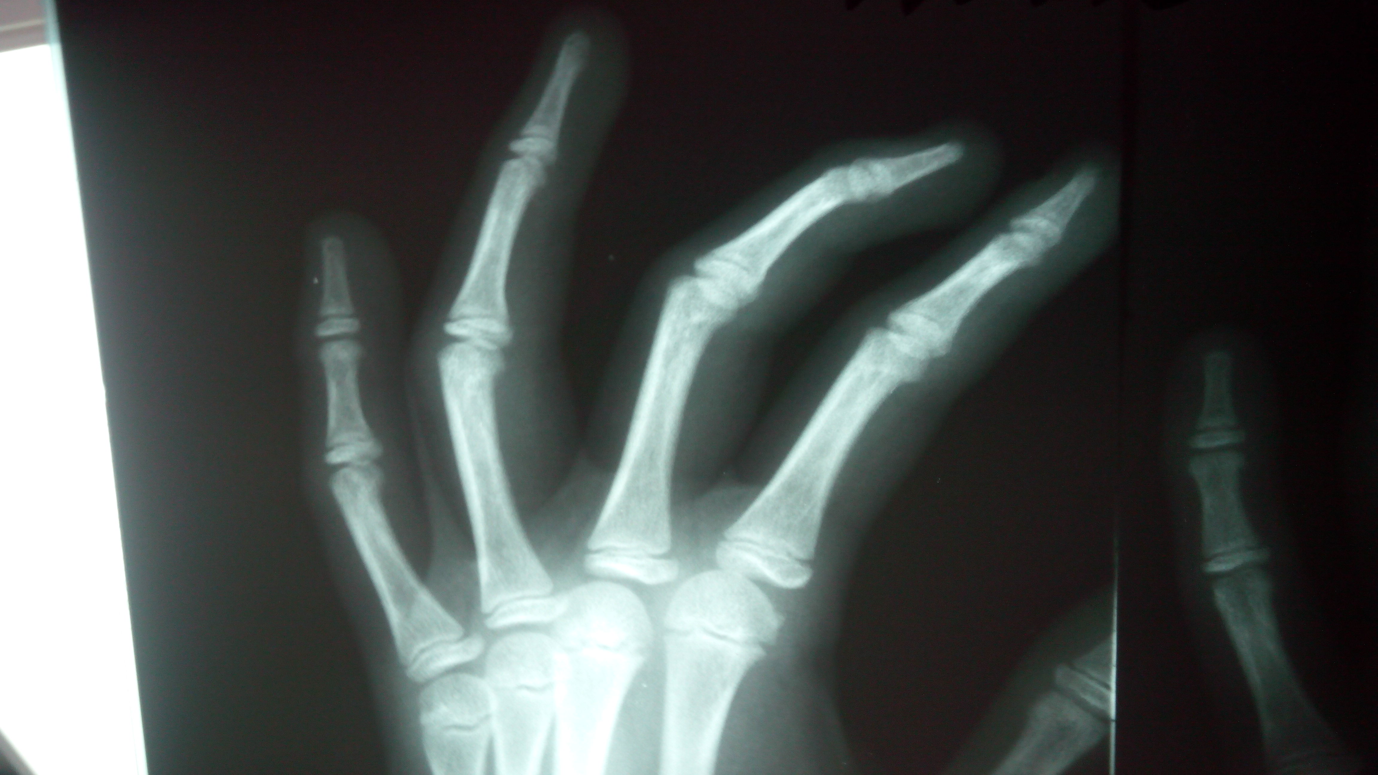 Трещина фаланги. Перелом проксимальной фаланги 4 пальца. Перелом фаланги пальца на руке рентген. Перелом фаланги мизинца на руке.