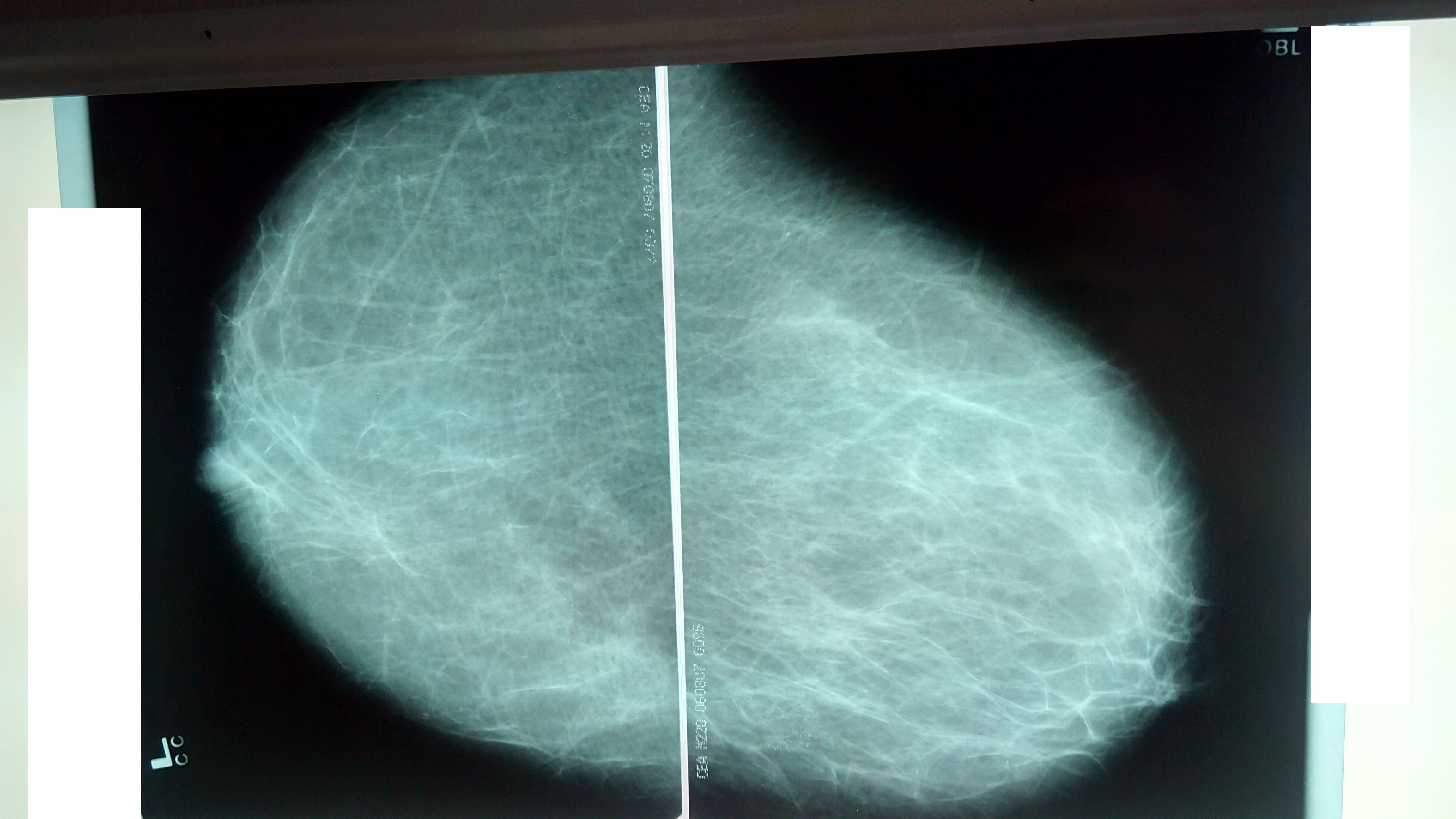 Обзорная рентгенография молочной железы