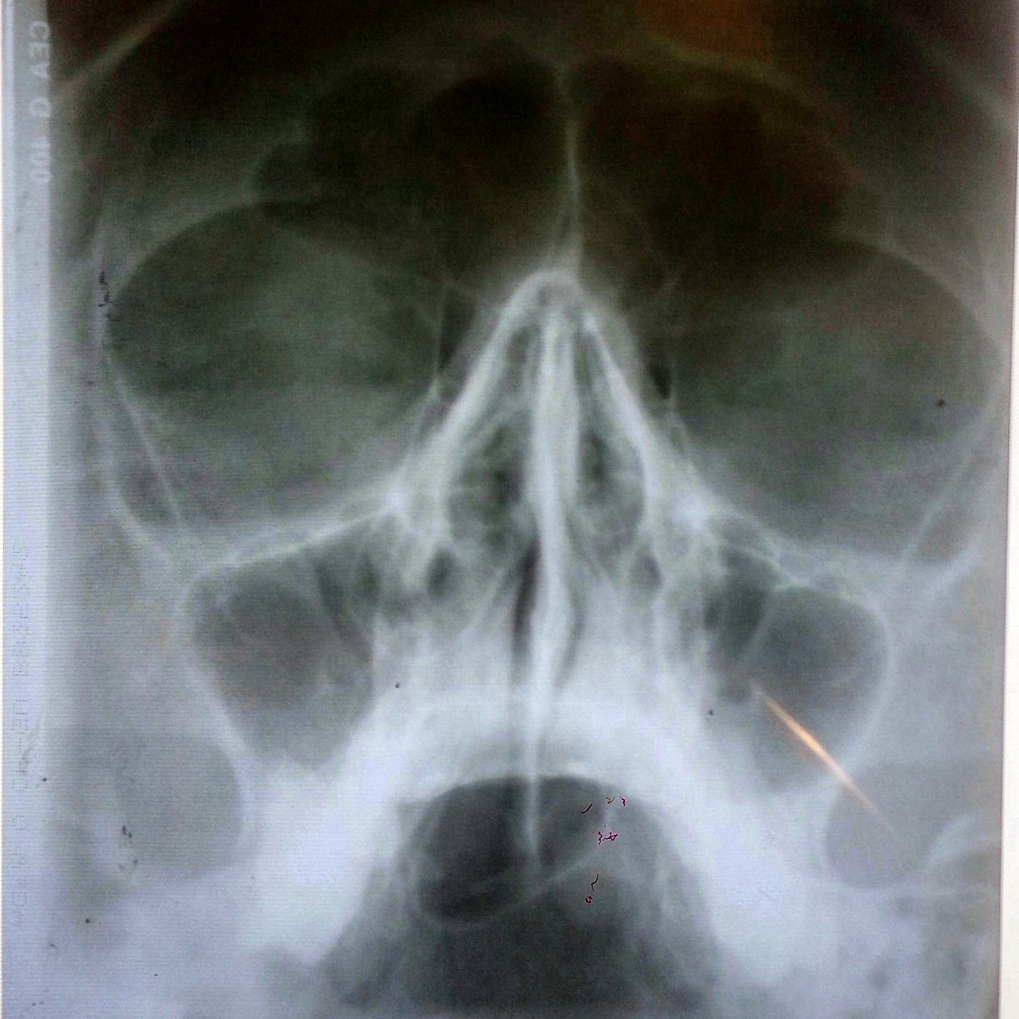 Рентген пазух носа фронтит