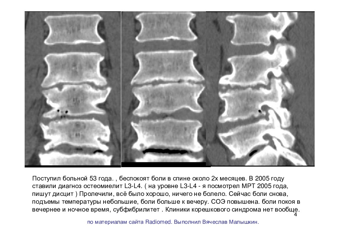 Спондилодисцит мрт картина