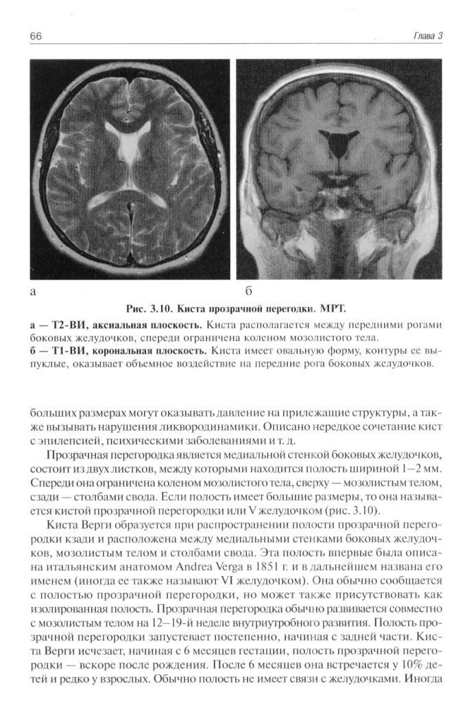 Полость расширена. Ликворная киста промежуточного паруса. Киста промежуточного паруса головного мозга мрт. Ликворная киста промежуточного паруса головного мозга. Киста полости Верге УЗИ.