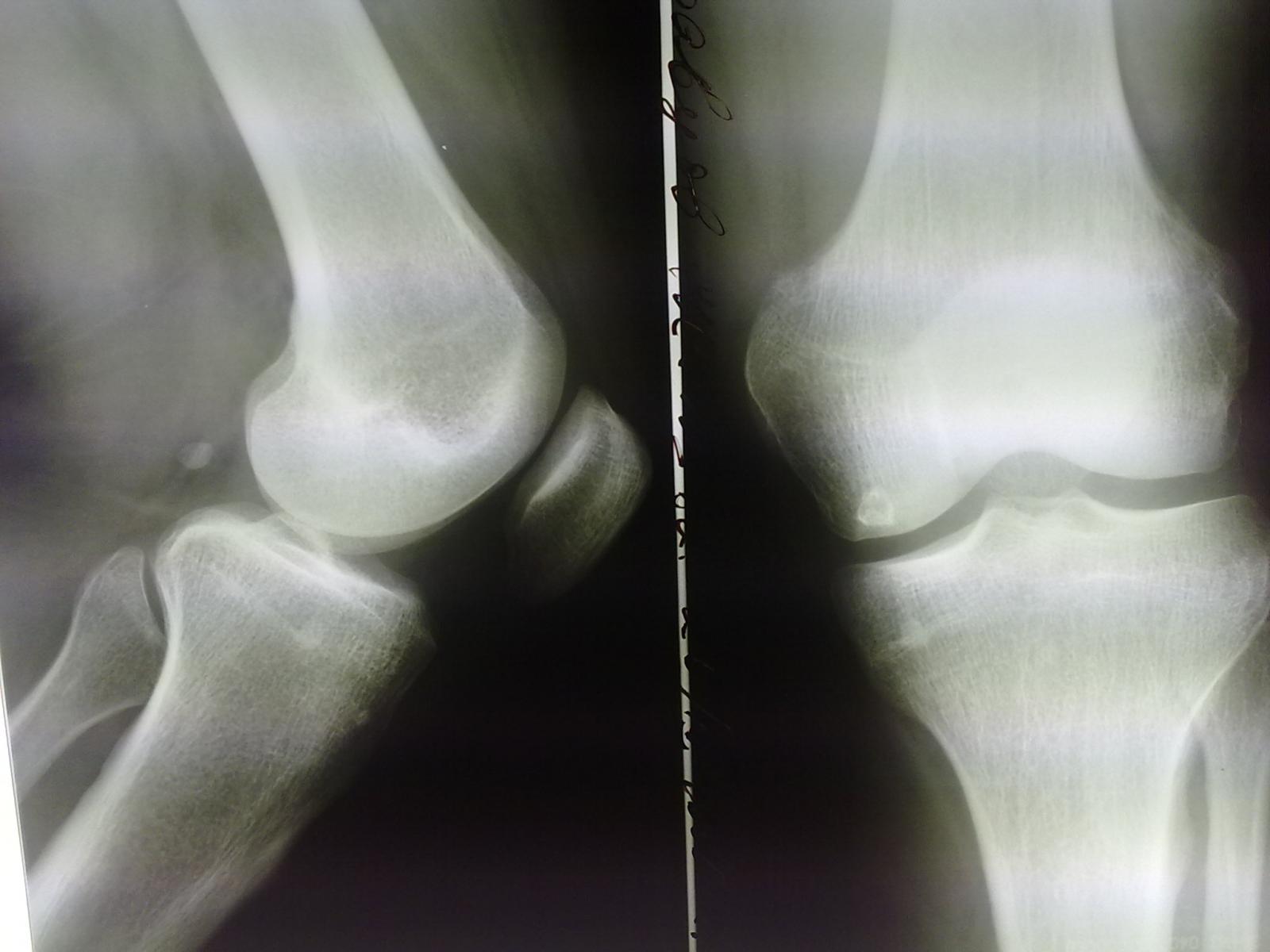 Рентген колена. Рентгенограмма коленного сустава в норме. Артроз коленных суставов рентгеногра. Доа коленного сустава на рентгене. Менисцит коленного сустава рентген.