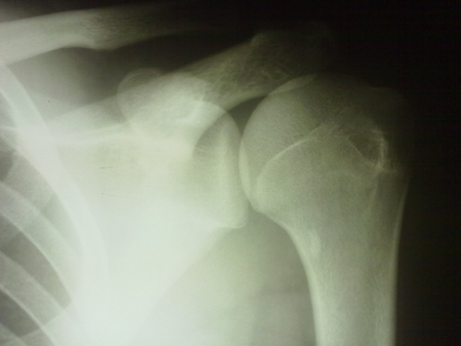 Перелом большого бугорка плечевой кости без смещения фото