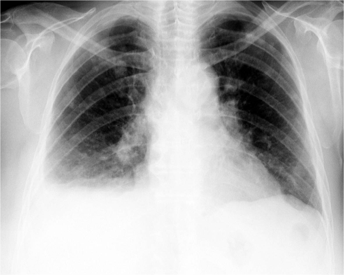 воспаление легких на снимке рентгена фото