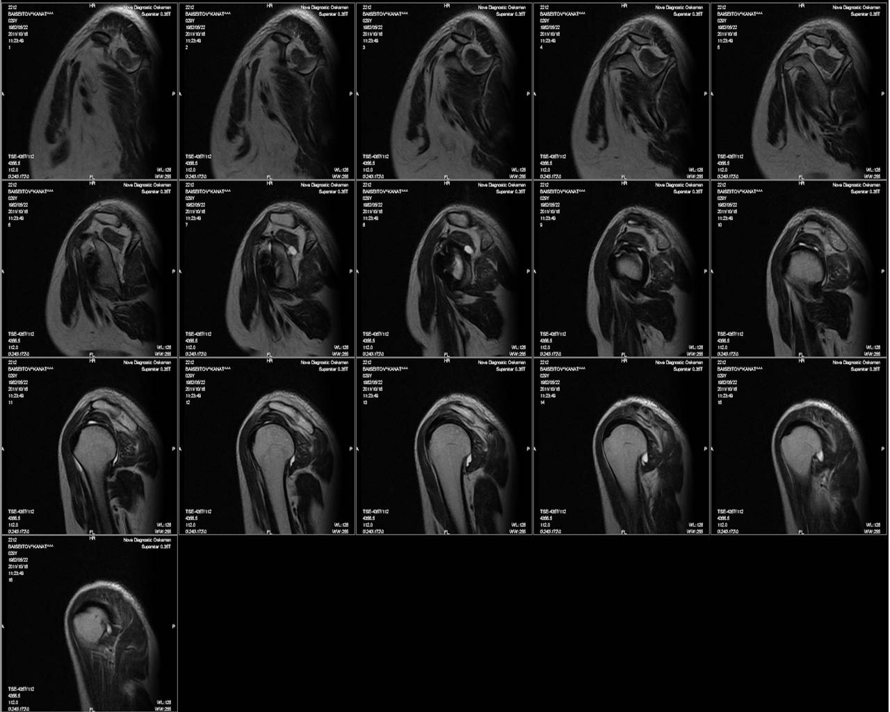 Мрт плечевого сустава. Снимок мрт плечевого сустава.