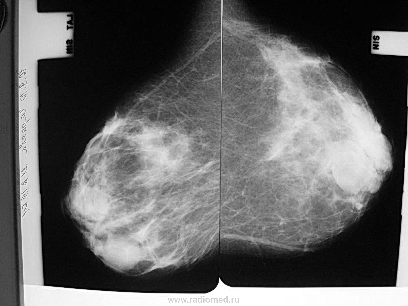 Тяжистый фиброз молочной железы на маммографии фото