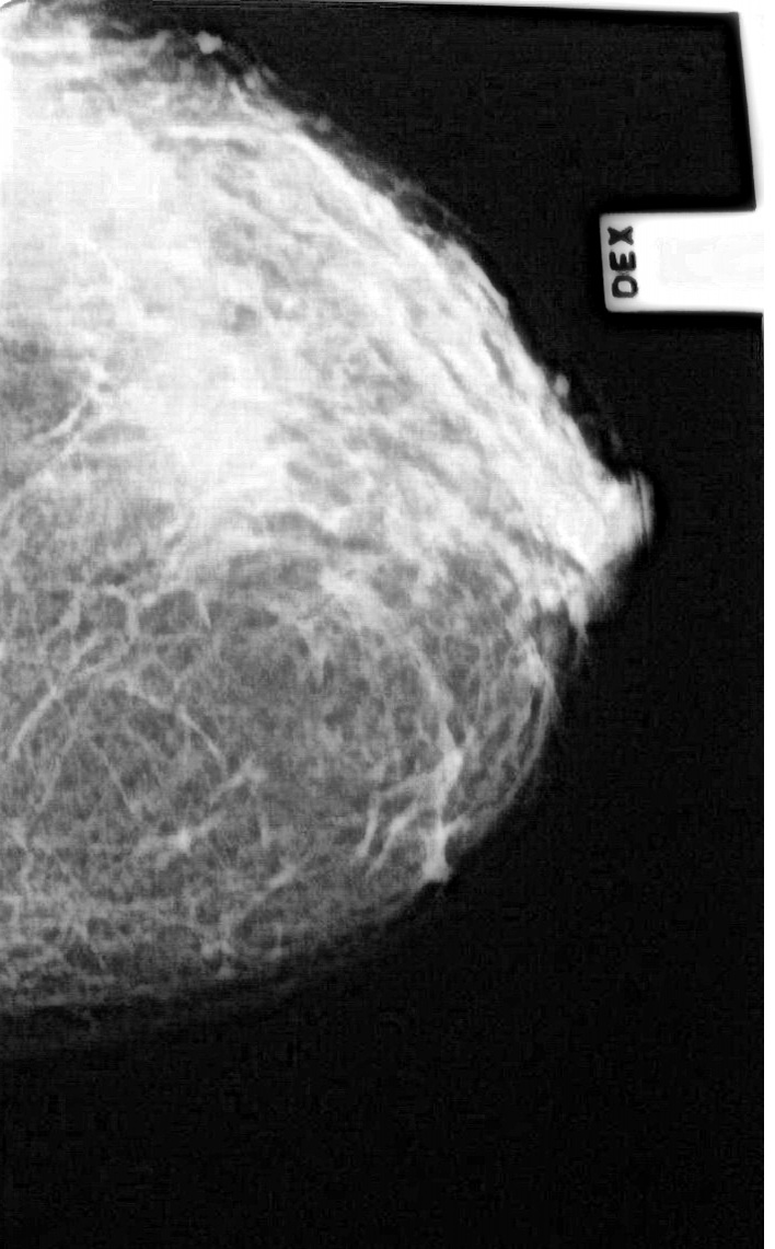 Маммография старый. Фиброзно кистозная мастопатия маммограмма. Фиброзно-кистозная мастопатия рентген. Мастопатия молочной железы маммограмма. Маммография рентген молочной железы.