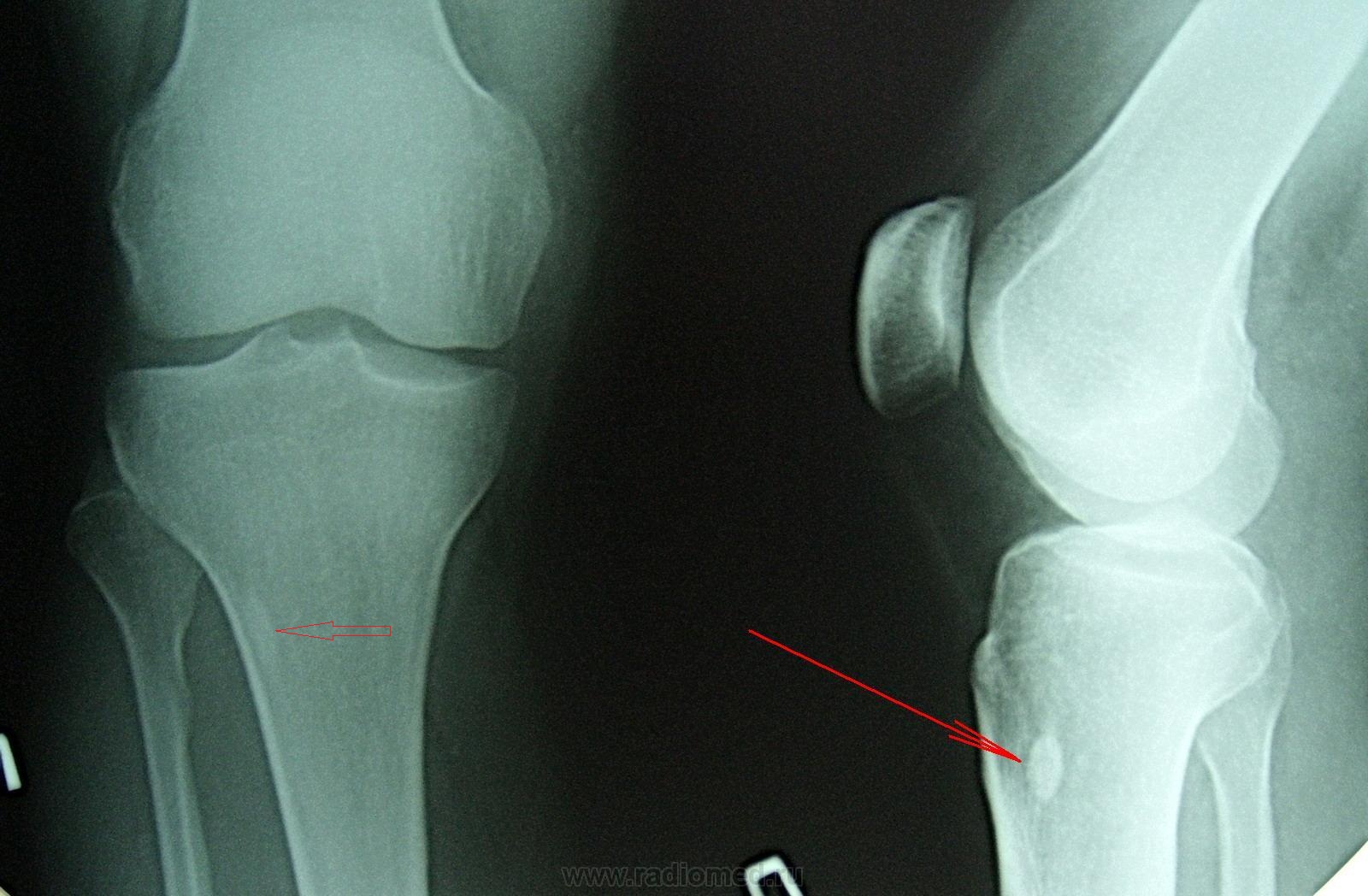 Трещина в коленной. Перелом коленного сустава рентген. Подвывих коленного сустава рентген. Перелом надколенника рентген. Подвывих смещение коленного сустава рентген.