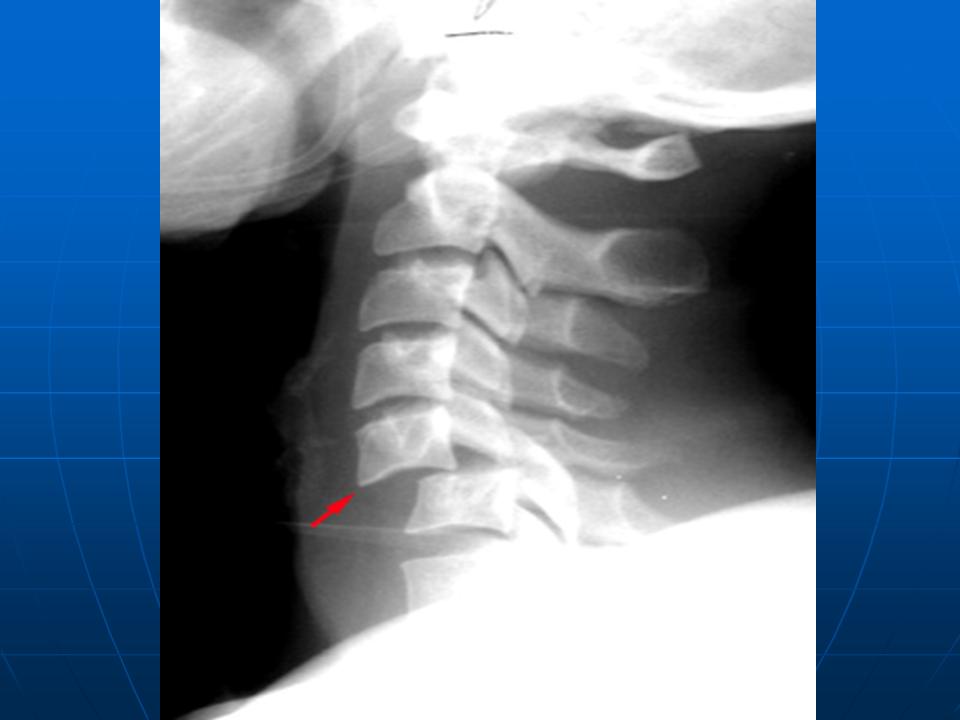 Односторонний разрыв. Подвывих 1 позвонка рентгенограмма. Травматический подвывих шейного позвонка рентген. Подвывих поясничного позвонка рентген. Подвывих с1 шейного позвонка рентген.