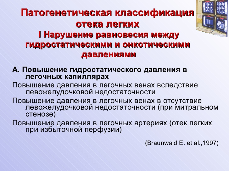 Отек легких сколько живут. Отек легких классификация. Отёк лёгких классификация. Патогенетическая классификация отеков. Отек легкого классификация.