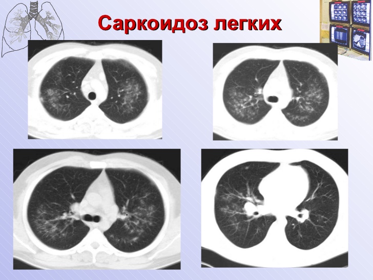 Саркоидоз легких. Кт картина саркоидоза. Милиарный саркоидоз кт. Саркоидоз лёгких кт симптомы.