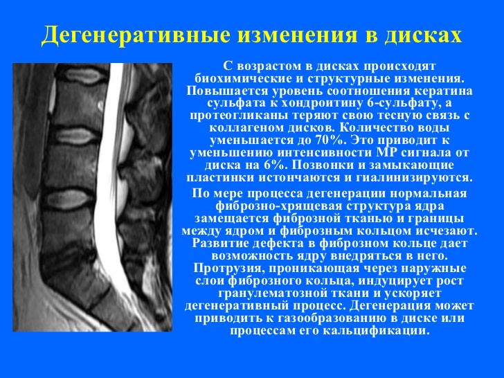 Картина дегенеративно дистрофических изменений пояснично крестцового отдела позвоночника что это