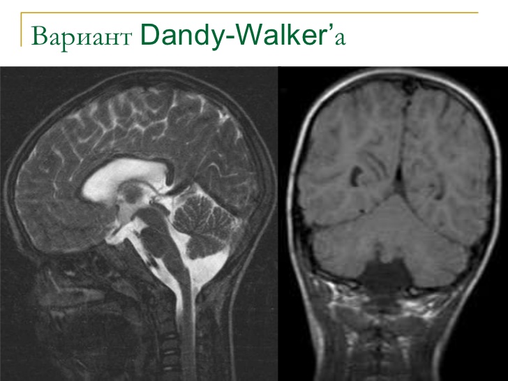 Синдром денди уокера картинки