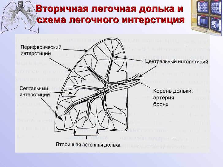 Отделы легочного рисунка. Вторичная легочная долька анатомия. Первичная легочная долька. Первичная и вторичная долька легкого. Строение вторичной легочной дольки.