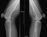 000004_web.ct_-_osteochondroma.jpg