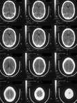 001920tuberculomas.jpg