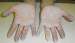 Цианоз пальцев